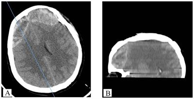 A case of spontaneous bilateral epidural hematoma associated with decreased coagulation factor XII activity: case report and literature review